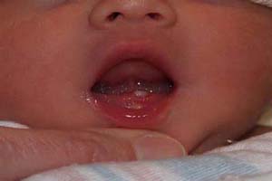 چرا بعضی از نوزدان در هنگام تولد ، " دندان " دارند ؟ 1