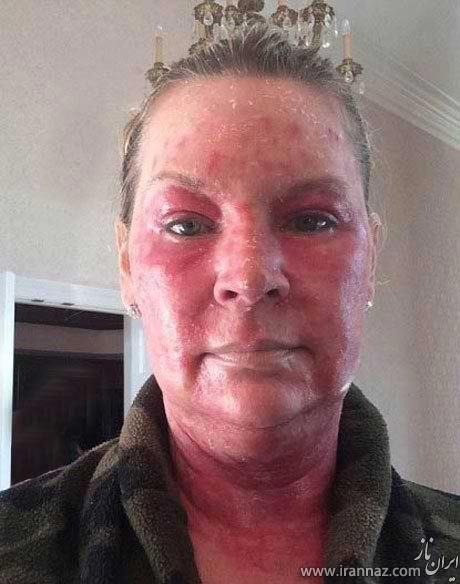 لیزر درمانی از خانم ثروتمند چهره ای وحشتناک ساخت! (عکس) 1