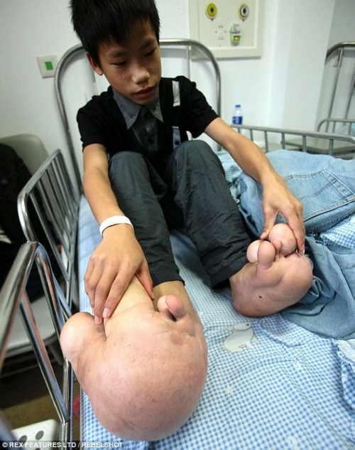 این پسر دارای عجیب ترین پاهای دنیا است (عکس)
