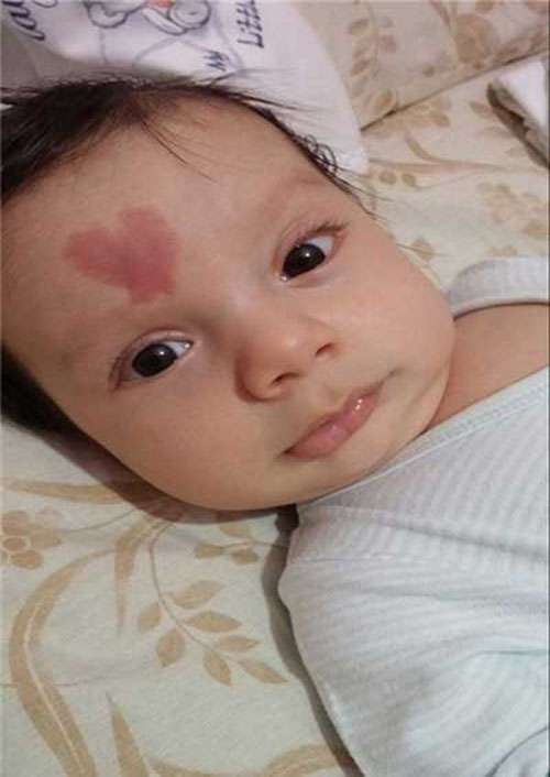 نوزاد که با علامت عشق روی صورتش بدنیا آمد +عکس