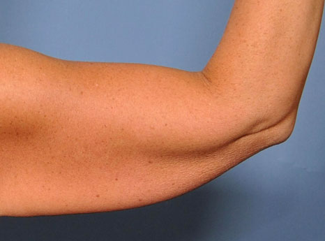 سریعترین روش رفع چاقی و افتادگی بازو