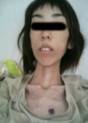 شکنجه های بی رحمانه و کاهش وزن شدید این دختر (عکس)