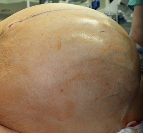 عمل خارج کردن تومور 60 کیلویی از رحم این زن (عکس 14+)