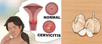 روش استفاده از سیر در واژن زنان برای درمان عفونت
