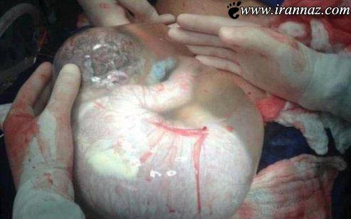 عکس های جنجالی از کودک به دنیا آمده در کیسه آب