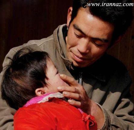 عکس های بسیار عجیب از کودکی که فاقد بینی است