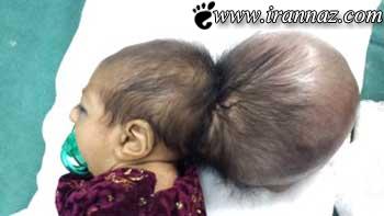 به دنیا آمدن نوزاد عجیب با یک سر اضافی (عکس)