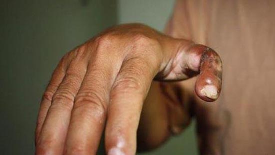 پیوند انگشت پا به دست این مرد چینی! (عکس)
