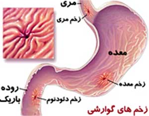 توصیه‌های غذایی در زخم‌ مری