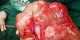 خارج کردن توده 14 کیلویی از بیمار آذربایجانی ( عکس)