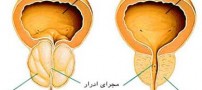 با علایم سرطان پروستات آشنا شوید
