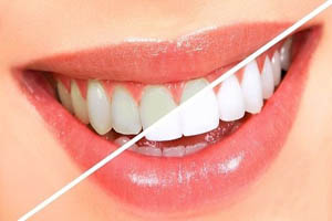 با این مواد طبیعی دندان های خود را سفید و براق کنید