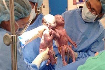 عکسی از تولد دوقلوهای کمیاب در آمریکا