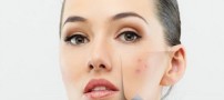 برای رفع جوش های صورت از طب سنتی کمک بگیرید