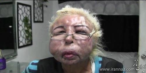 این خانم با خود درمانی صورتش را از بین برد! (عکس)