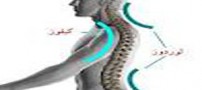یک عامل مهم در افزایش گودی کمر