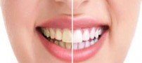 روش هایی برای از بین بردن زردی دندان ها