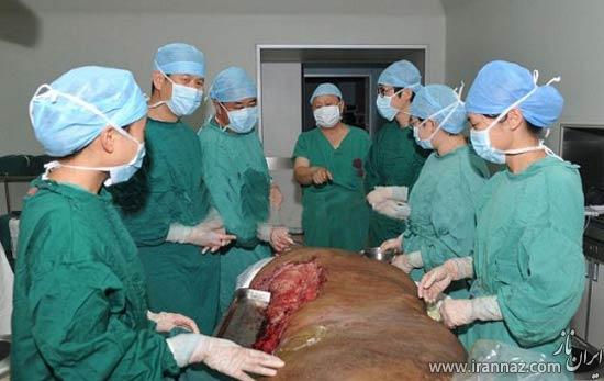 جراحی تومور 110 کیلویی در پای این مرد! (عکس)
