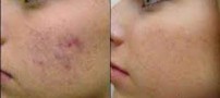 آیا راهی برای بستن منافذ باز شده پوست وجود دارد؟