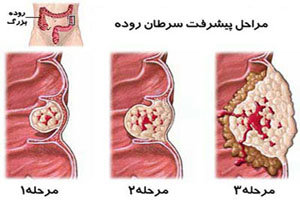 آنچه باید درباره بیماری پولیپ روده بزرگ بدانید