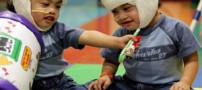 جشن دهمین سالگرد جدایی دوقلوهای فیلیپینی! (عکس)