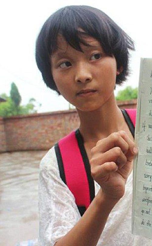 بیماری عجیب دختر 14 ساله به نام مرد سنگی (عکس)