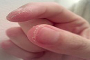 درمان های خانگی انگشتان پوسته پوسته شده