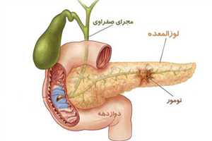علائم، تشخیص و درمان بیماری لوزوالمعده