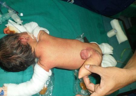 نوزادی که با یک دم به دنیا آمد! (عکس)