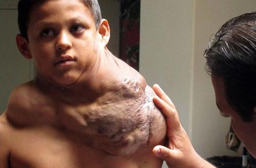 وجود یک تومور سنگین روی شانه پسر 11 ساله (عکس)