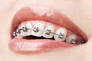 همه چیز درباره ارتودنسی دندان ها