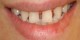 دندان های فاصله دار را چگونه درمان کنیم؟