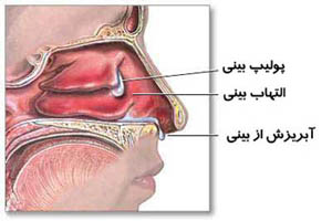 بینی چگونه دچار گرفتگی می شود؟