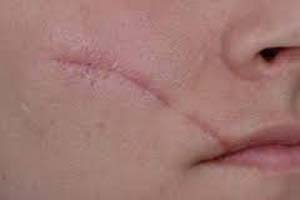 علت باقی ماندن جای زخم روی پوست چیست؟