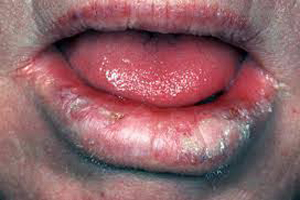این علامت نشانه سرطان زبان است