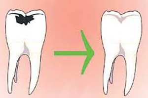 شیوه ای جدید برای جلوگیری از پوسیدگی دندان