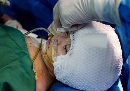 اولین عمل باسازی جمجه این دختر در ایران (عکس 18+)