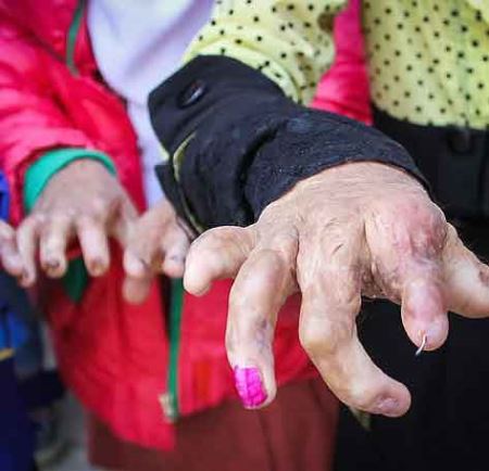 چهره های دردناک دختران سوخته شین آبادی و اعتراض در تهران