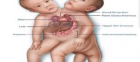 عکس های دیدنی از جداسازی پیچیده ترین دوقلوهای دنیا