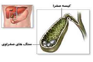 اصلی ترین عامل سنگ صفرا چیست