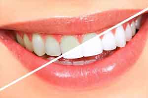 روش سفید کردن دندان ها در خانه