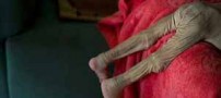 پوست و استخوان شدن این کودک بخاطر  (عکس 18+)