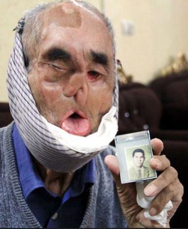 محمد زاده جانبازی با صورتی عجیب (عکس) محمد زاده جانبازی با صورتی عجیب (عکس)