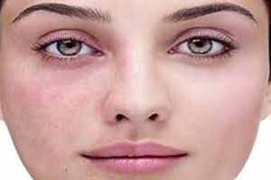 دلیل اصلی ایجاد کک و مک در صورت و بدن
