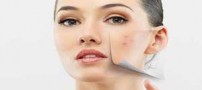 آموزش محو کردن جوش صورت با آرایش