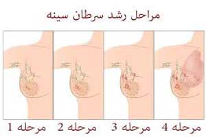 کیست سینه نشانه چیست؟