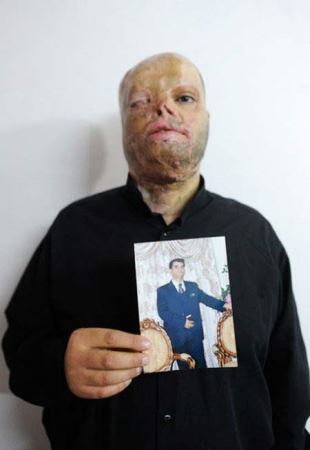 رازهای تکان دهنده زندگی قربانیان ایرانی اسید پاشی (18+ عکس)