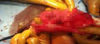 29 آهنربا و باتری از شکم کودک 3 ساله خارج شد (عکس)