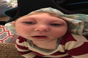 شکل عجیب نوزادی 15 ماهه با بیماری کوچکی جمجمه (عکس)