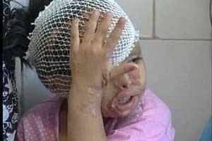 یک سطل اسید، آینده این دختر کوچولو ناز را نابود کرد